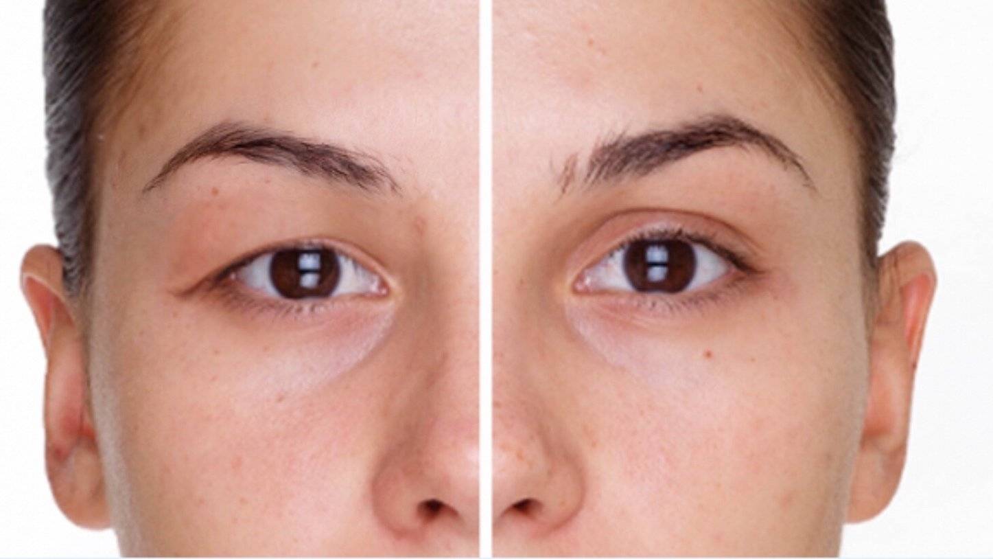 dr akyol goz kapaklarindaki sarkmalar gorme guclugune yol acabiliyor h6BrWeTO